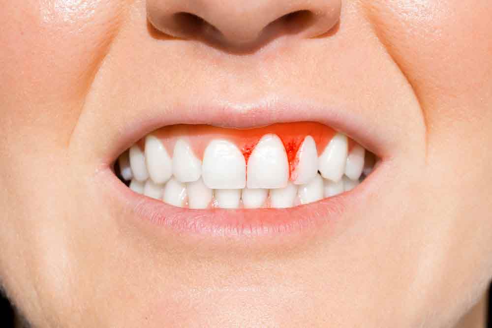 Gingivitis Nedir?